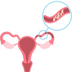 Understanding the Fallopian Tubes