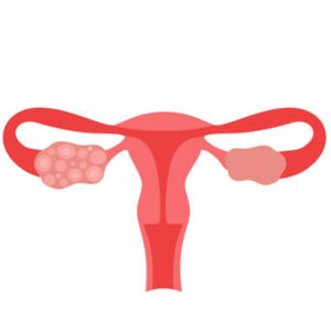 PCOS