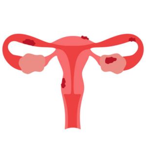 Endometriosis