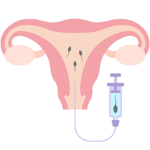 Understanding IUI and How It Works